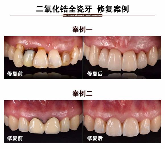 钛合金烤瓷牙